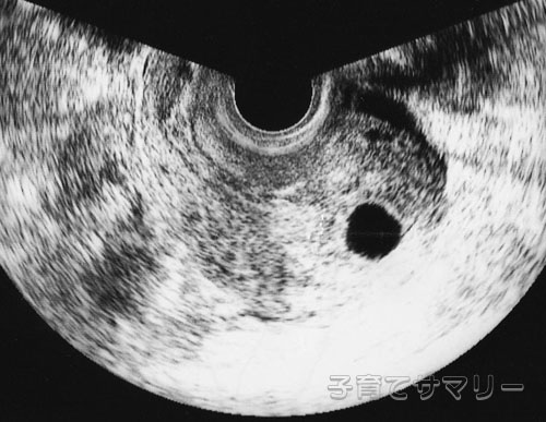 妊娠5週目の超音波写真1