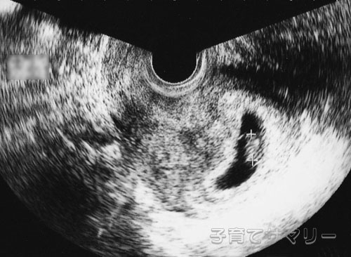 妊娠7週目の超音波写真1