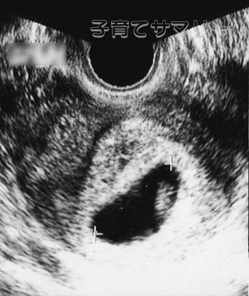 妊娠7週目の超音波写真2