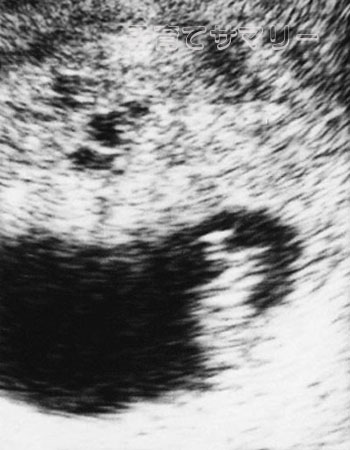 妊娠7週目の超音波写真3
