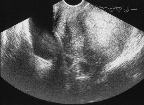妊娠11週目の超音波写真1