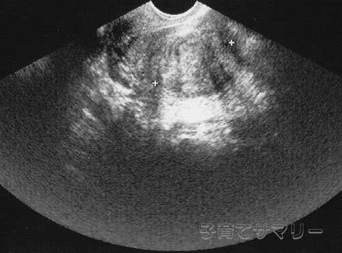 妊娠11週目の超音波写真2