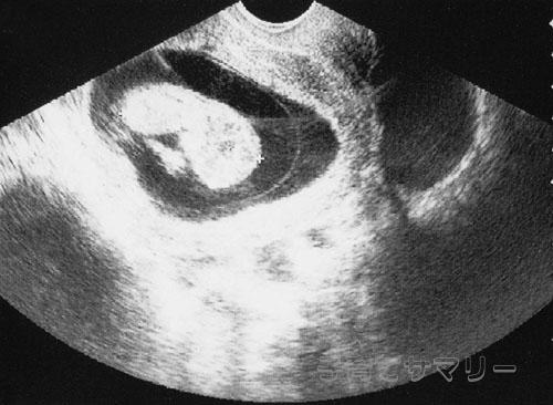 妊娠11週目の超音波写真3