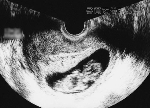 妊娠12週目の超音波写真1