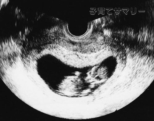妊娠12週目の超音波写真2