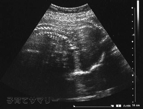 妊娠24週目の超音波写真1