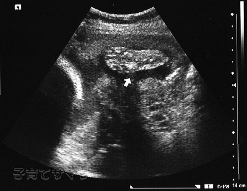 妊娠26週目の超音波写真1
