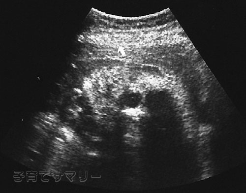 妊娠28週目の超音波写真1