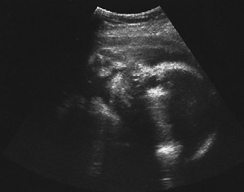 妊娠30週目の超音波写真1