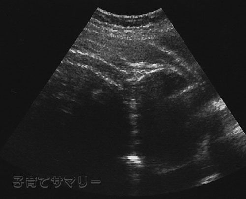 妊娠32週目の超音波写真1
