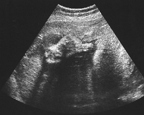 妊娠34週目の超音波写真1